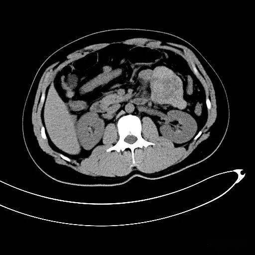 胰腺腺泡细胞癌