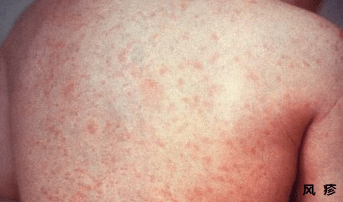 新冠肺炎早期皮肤图片