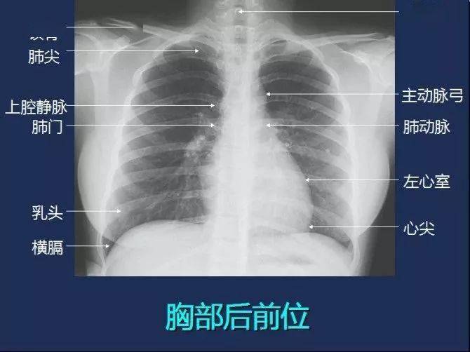 各种肺炎x线胸片图解图片