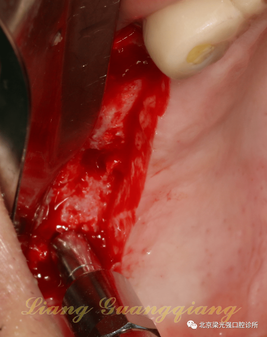 牙医学堂上颌窦膜破裂后二次种植