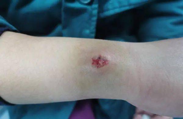 许丽敏被一名因车祸住院的患者咬伤,包扎完伤口后强忍疼痛仍坚持工作