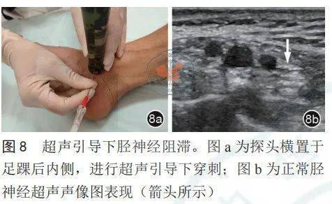 超声引导下外周神经阻滞技术专家共识