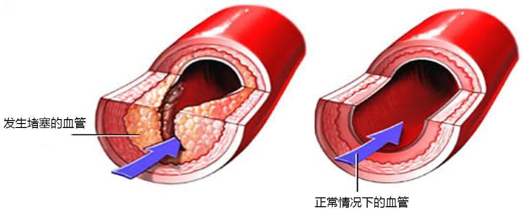 雪儿老师公开课血管的隐形炸弹肥胖过度的后果比你想得更恐怖