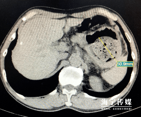 接诊的朱忠杰大夫得知孙大叔这一病情后,首先给他做了腹部ct,提示 胃