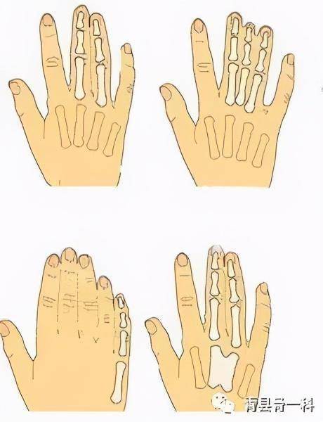 先天手指畸形或是抽烟导致_综合征