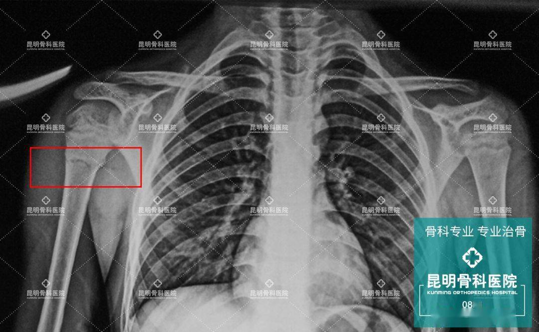 不出所料,经拍片后显示,小安发生了右肱骨近端骨折