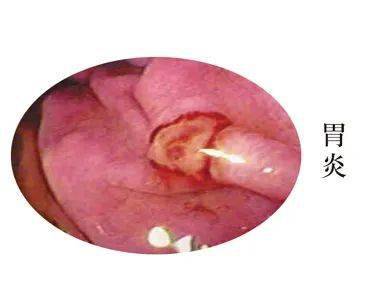 别等身体发出"报警"再治疗_幽门