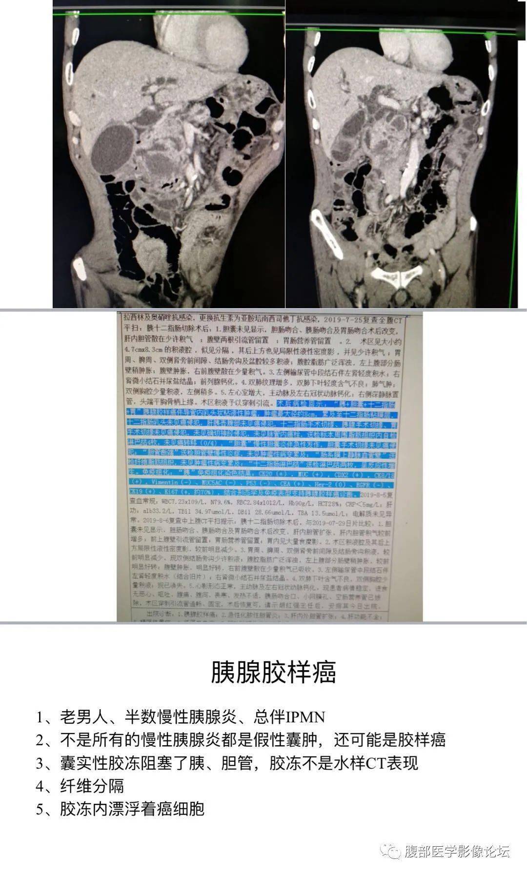 蟹足状肿瘤图片