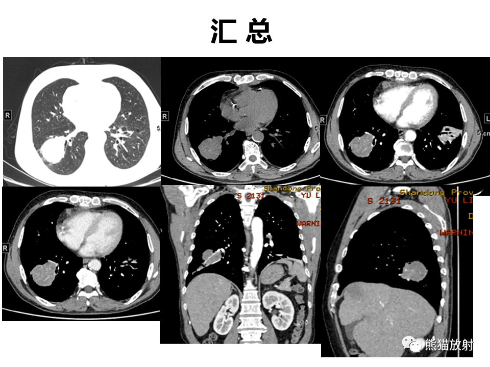 肺大细胞癌图片