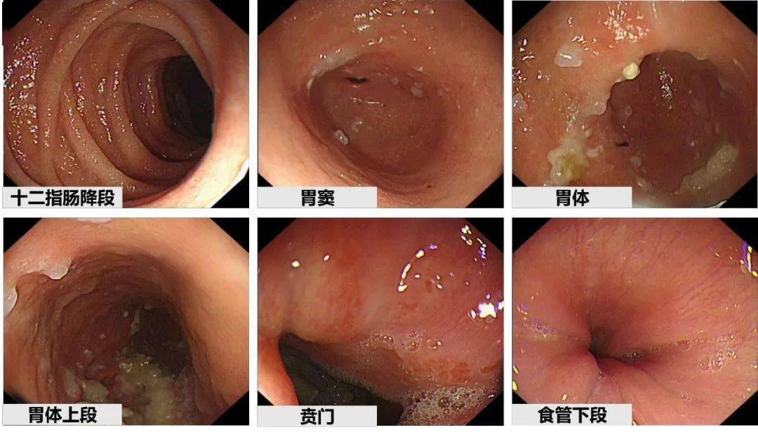 急性肠胃炎胃镜图片图片