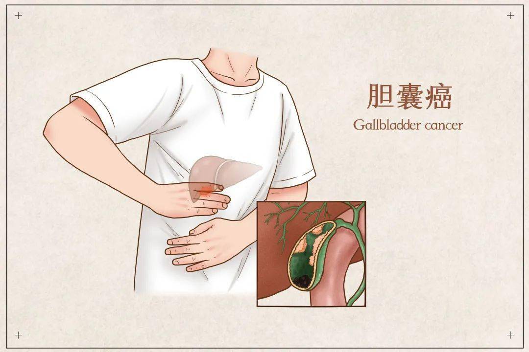 人体内有个小袋子,出了问题可能引发癌症,有些坏习惯是该改改了!