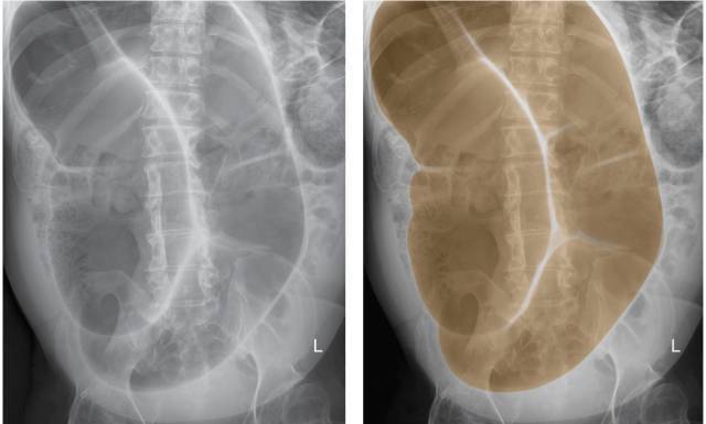 小肠扭转x线图片图片