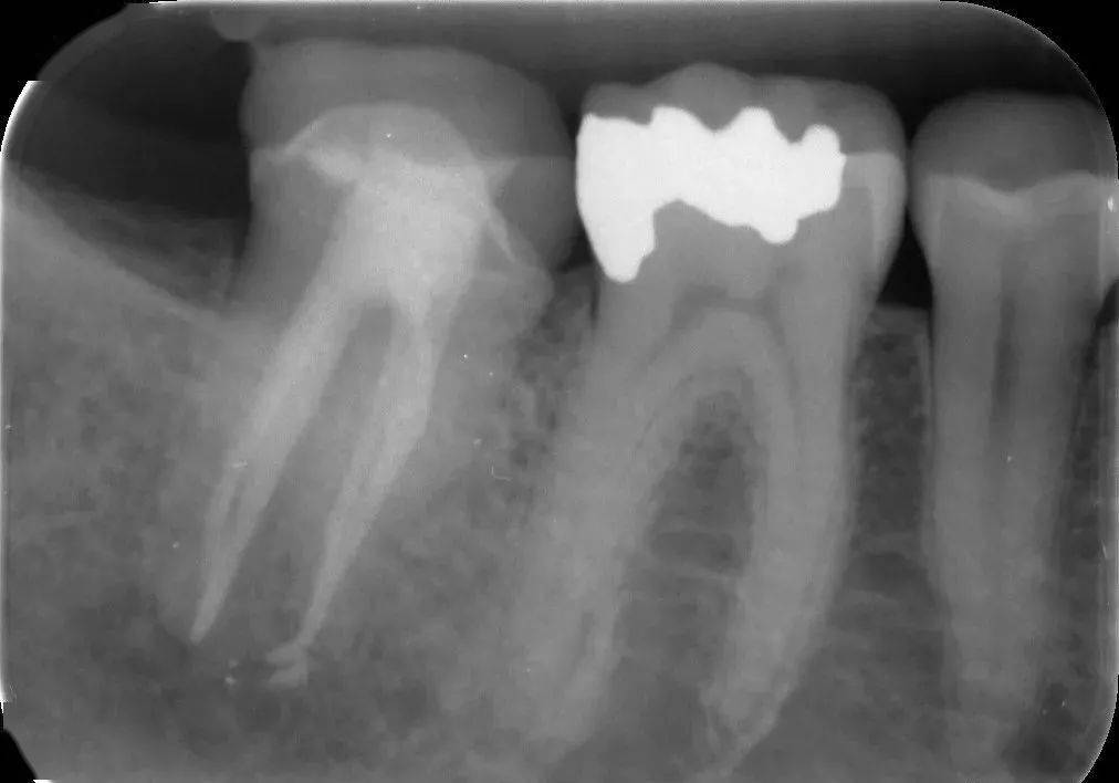 急性牙髓炎一次性根管充填和多次根管治疗后充填哪个好?