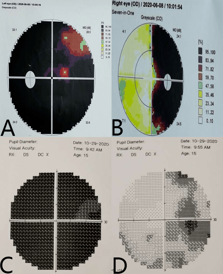 视力较术前略有减退,为手动;右眼颞侧视野完全缺损,鼻侧缺损缓解