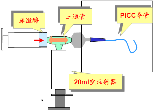 picc三通溶栓示意图图片