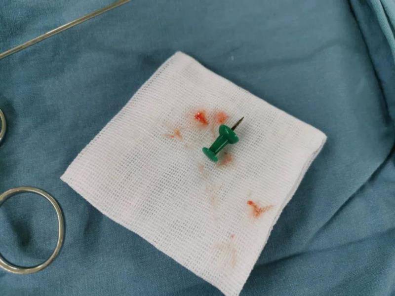 一颗图钉突然被吸入9岁男童的喉咙里,瞬间进入气道深部,危险重重.