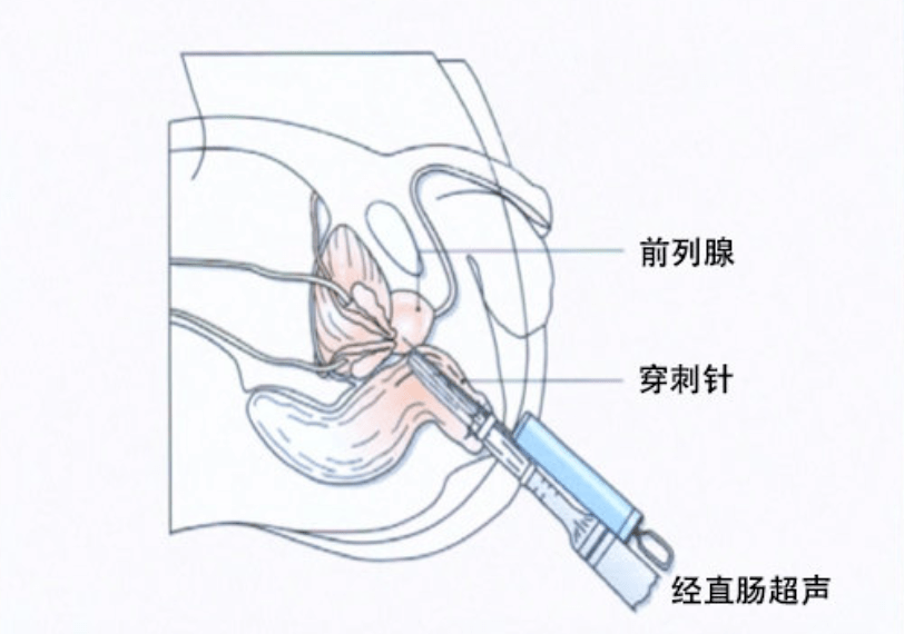前列腺癌的经典影像学检查