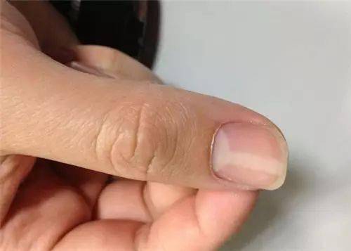 如何从手指上月牙判断你的体质