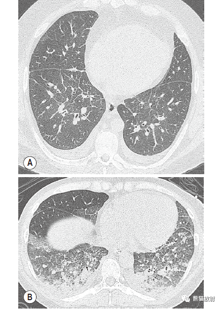 格艾選讀丨肺水腫機制x線及ct表現