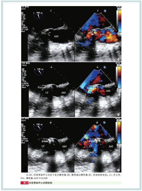 经食管超声心动图引导 fustartm可调弯鞘封堵主动脉瓣瓣周漏手术经验