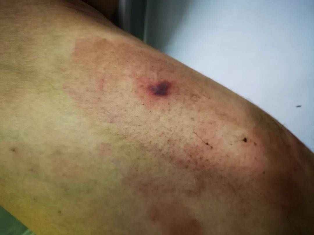 被蜜蜂群围攻,身上拔出70多根刺!记住医生提醒,关键时刻能救命