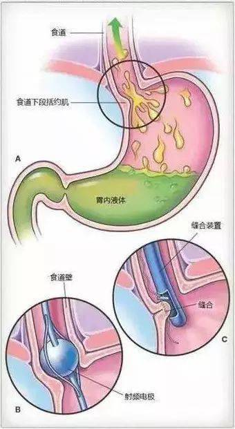 環甲膜穿刺的體位與手法如何為氣管切開術後的患者吸痰氣管插管纏繞