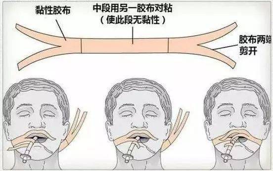 刚入职的年轻护士必懂的常见临床操作图解收藏
