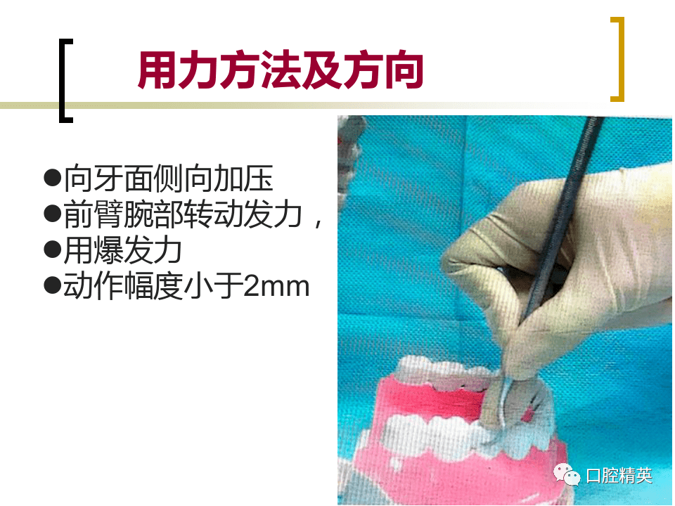 龈上洁治术67