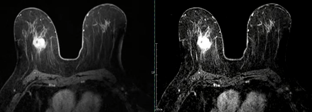 庐江女性福音 县医院开展乳腺mri