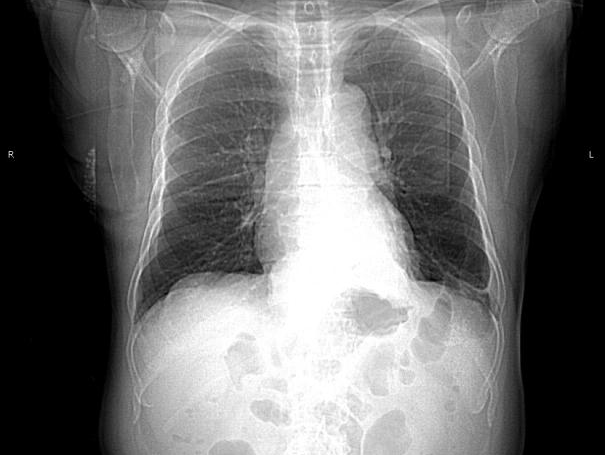 胸腔胃一块压在患者心上的大石头