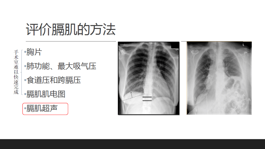 临床指南与知识更新膈肌超声的应用