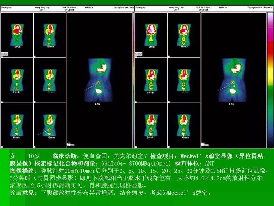 梅克尔憩室超声图表现图片