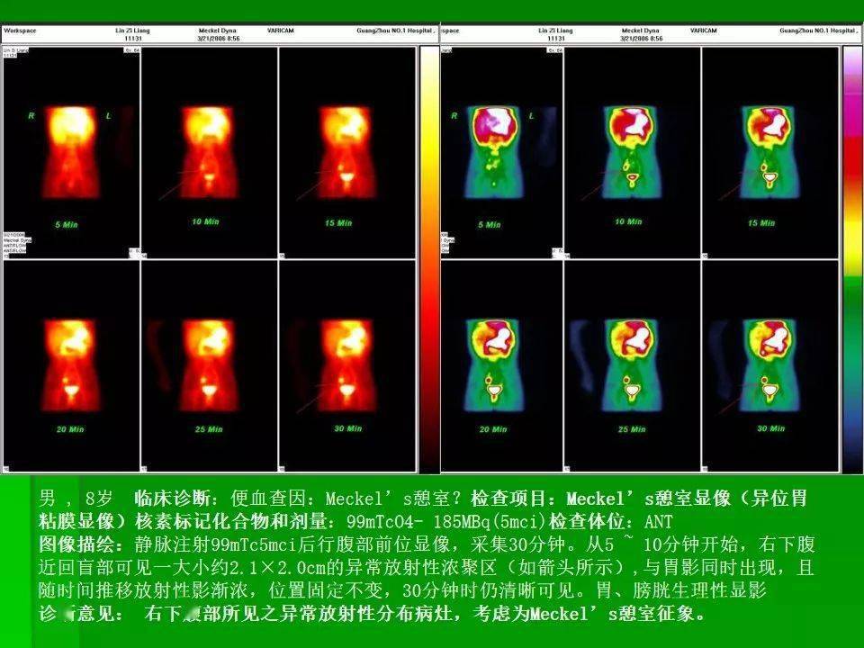 梅克尔憩室超声图表现图片