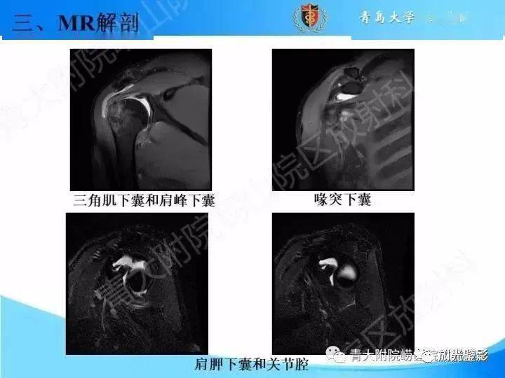 肩關節mri解剖肩袖損傷診斷技巧