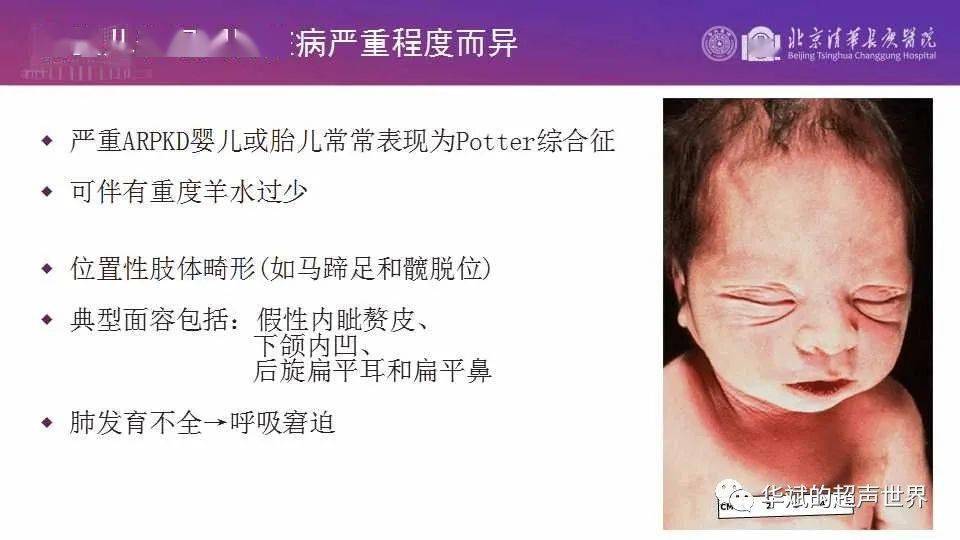 病例讨论与文献学习caroli病caroli综合征