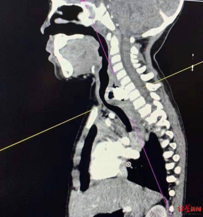 4歲女娃吃不下飯,喘不過氣,醫生從食管裡取出一枚紐扣電池