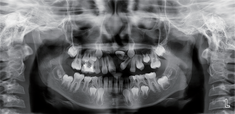 牙齿曲面断层片图片
