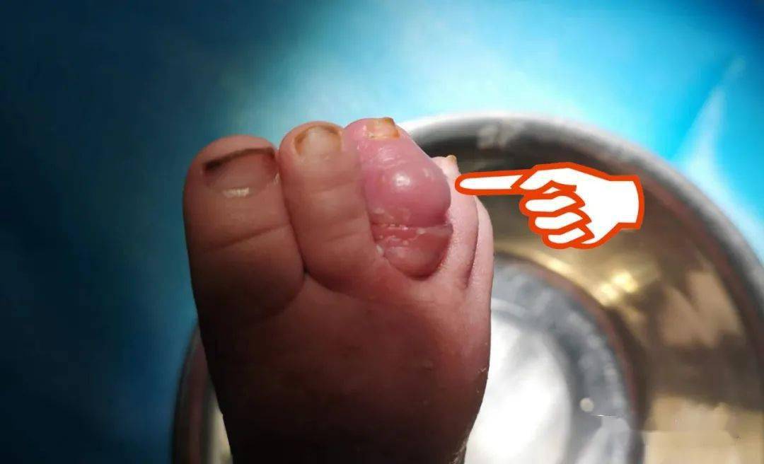 【警惕】一根头发丝儿,差点要了孩子的脚趾头!