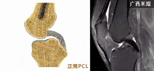 后交叉韧带(pcl)损伤的mri诊断