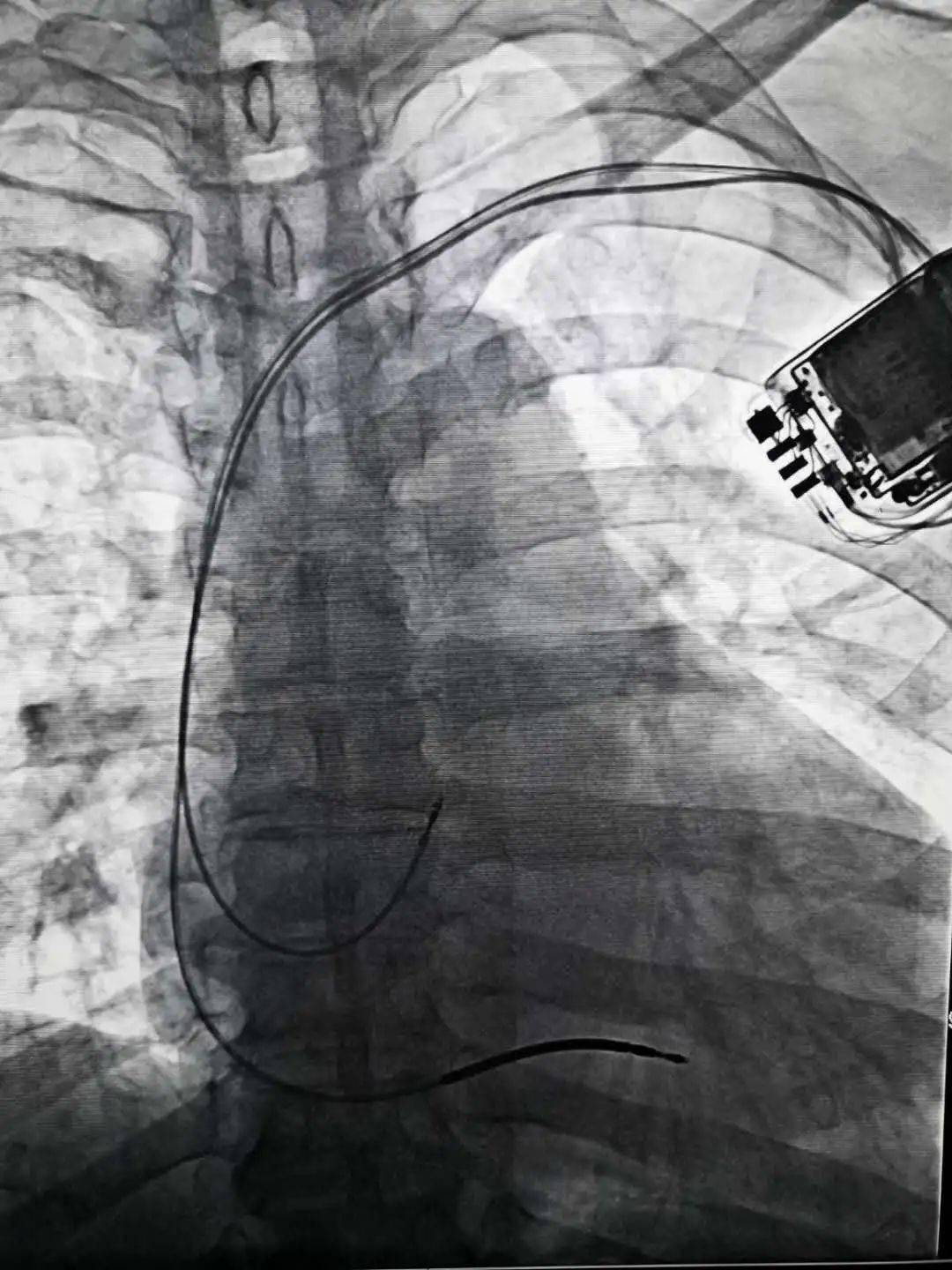 植入式心脏复律除颤器图片