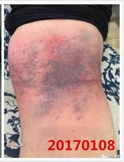 四次拍痧的变化