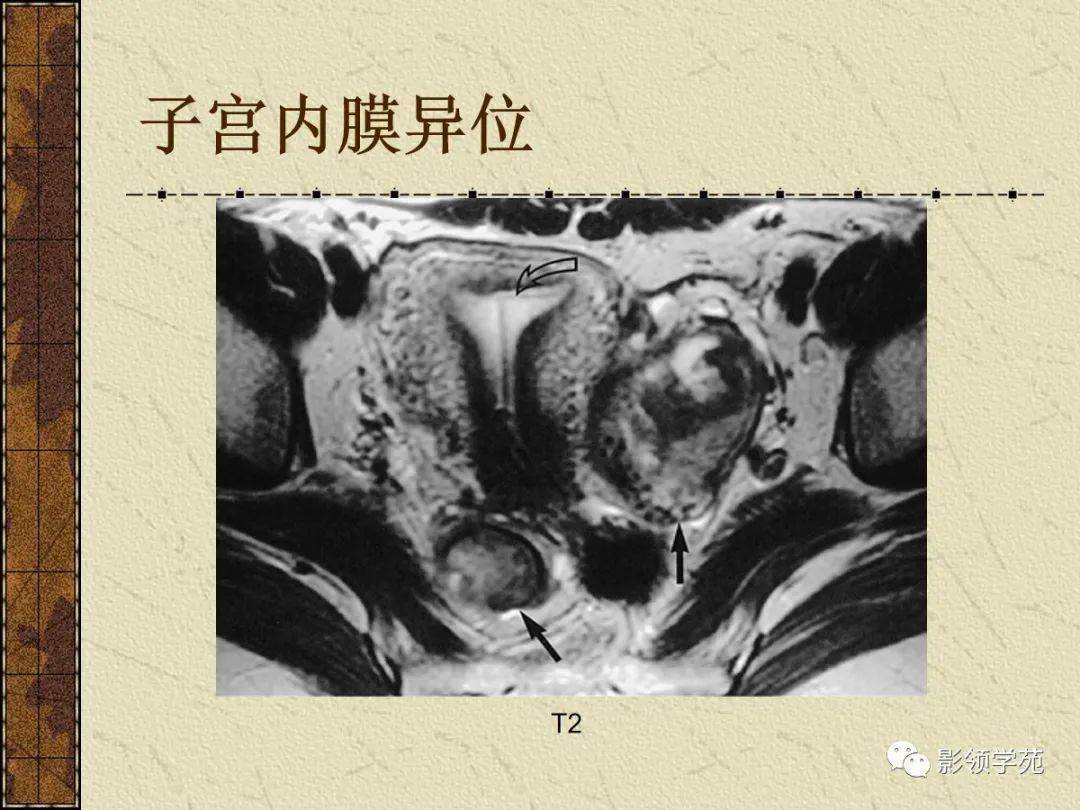 子宫MR解剖图片