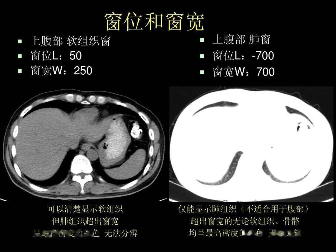 腹部ct入门解剖图谱收藏版