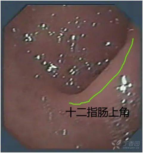 從球部進入降部有一定的難度,向前進鏡到十二指腸上角右側視野即將