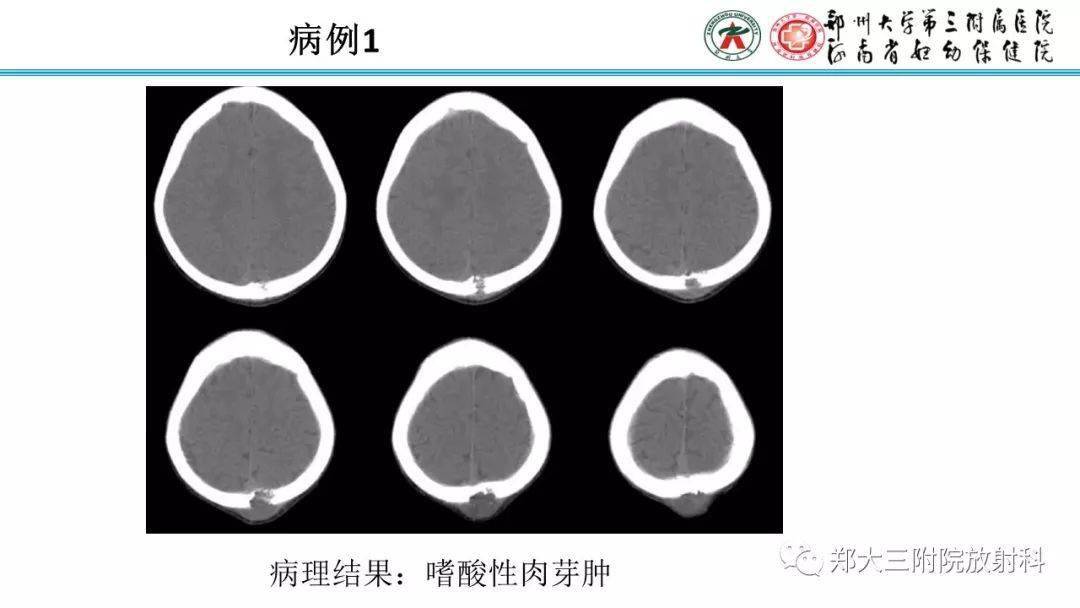 骨嗜酸性肉芽肿图片