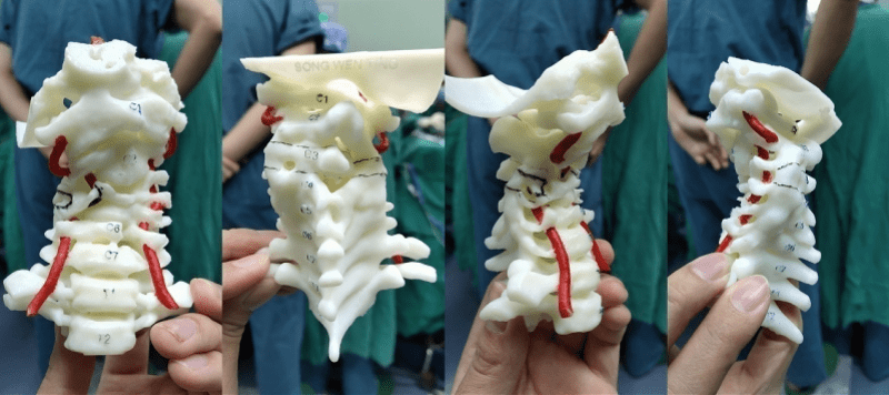 颈椎侧弯手术图片