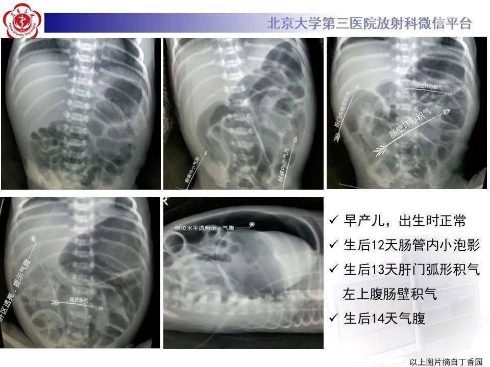 每日一例1203女4天腹部膨隆肠鸣音减弱