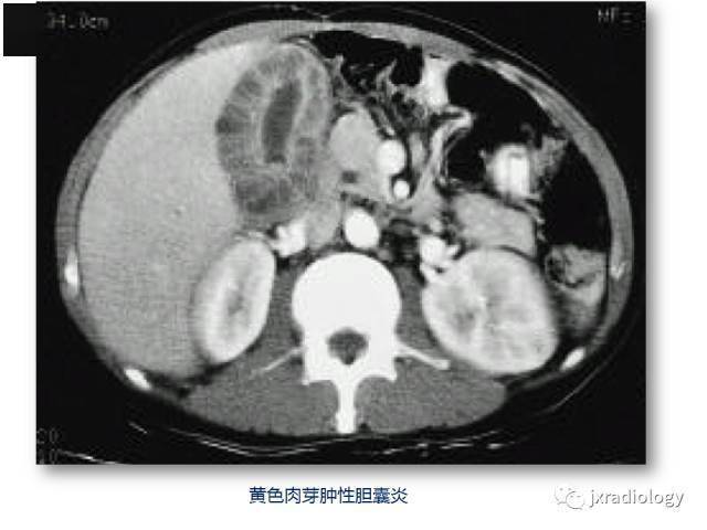 胆囊壁增厚的影像鉴别诊断