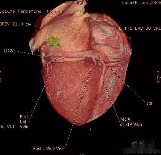 影像解剖 | 心臟冠狀動脈ct解剖中文詳細標註(圖文)