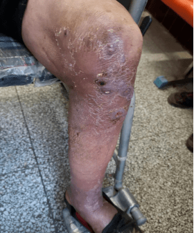 近日新蔡同安医院多学科会诊治愈一例罕见病诺卡氏病